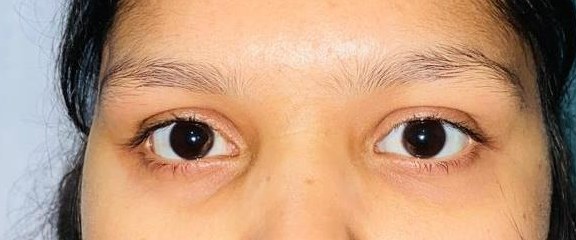 Squint, after