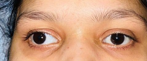 Squint, before