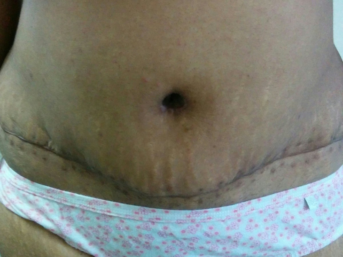 Tummy Tuck, after