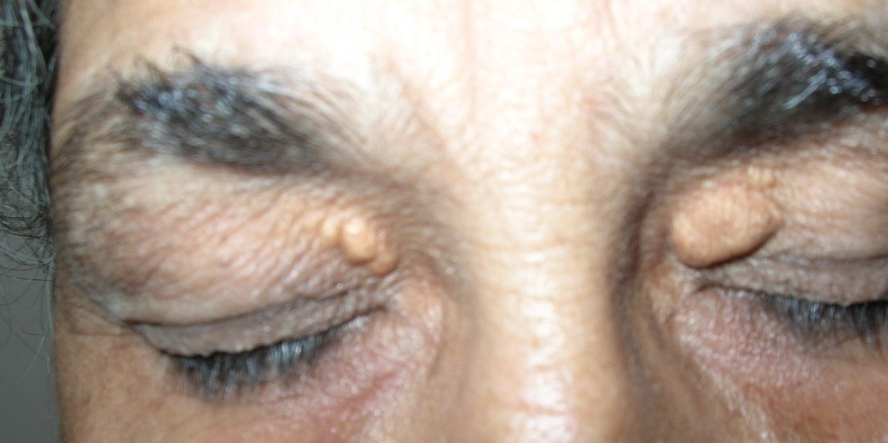 Xanthelasma, before